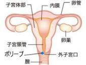 子宮頚管ポリープ.jpg
